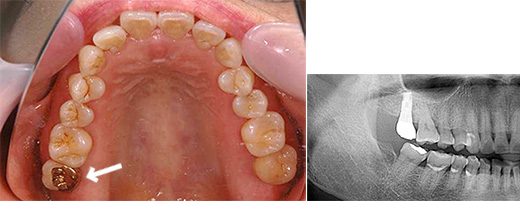 奥歯を1本失った